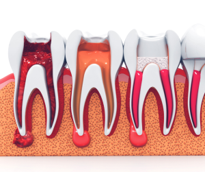 how to prepare for a root canal
