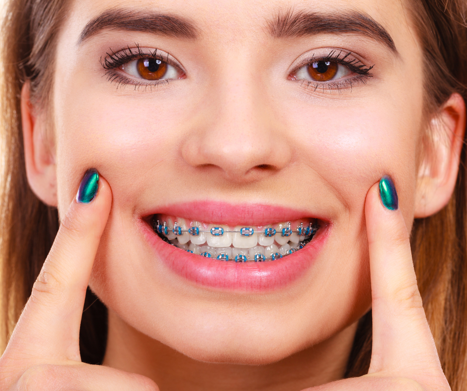 Types of Dental Braces Ashburn VA Lans Family Dentistry
